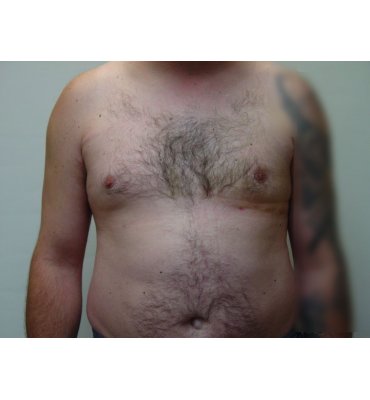 gynecomastio after